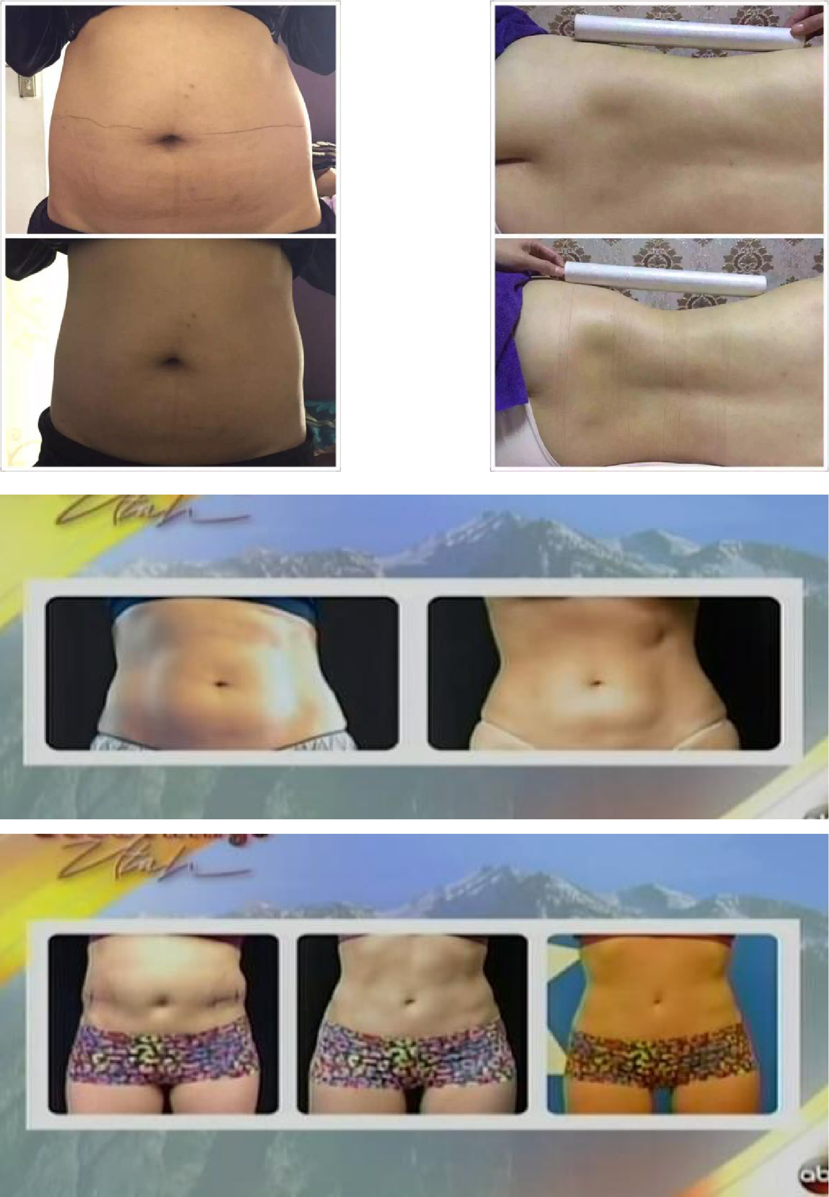 effect of ultrasound body slimming